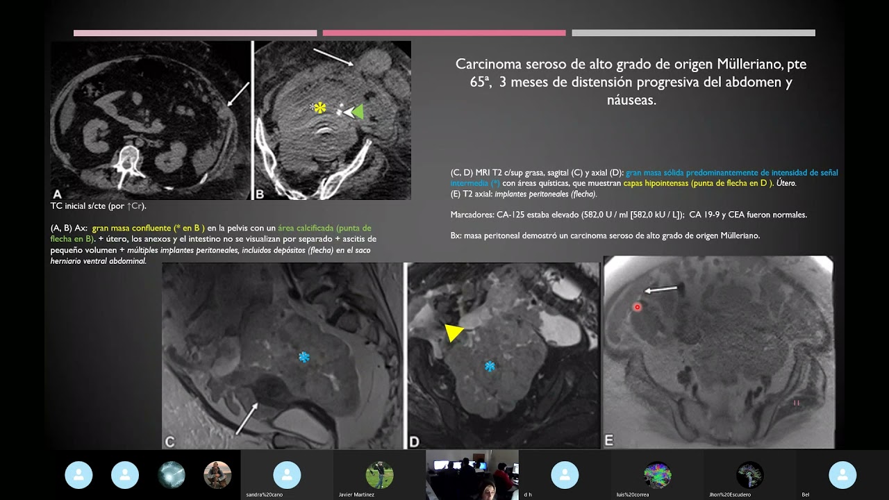 Cáncer de Ovario  Marcadores Séricos en el Tratamiento