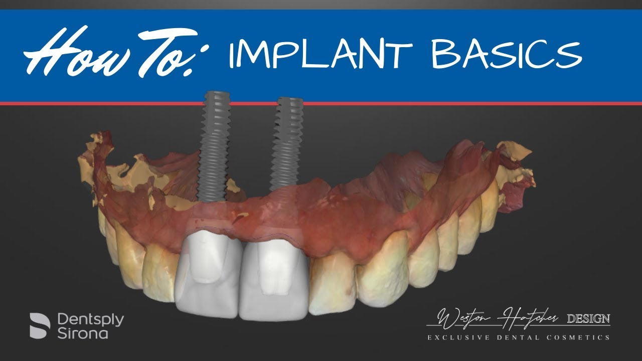 Step-by-Step Implant Design Process
