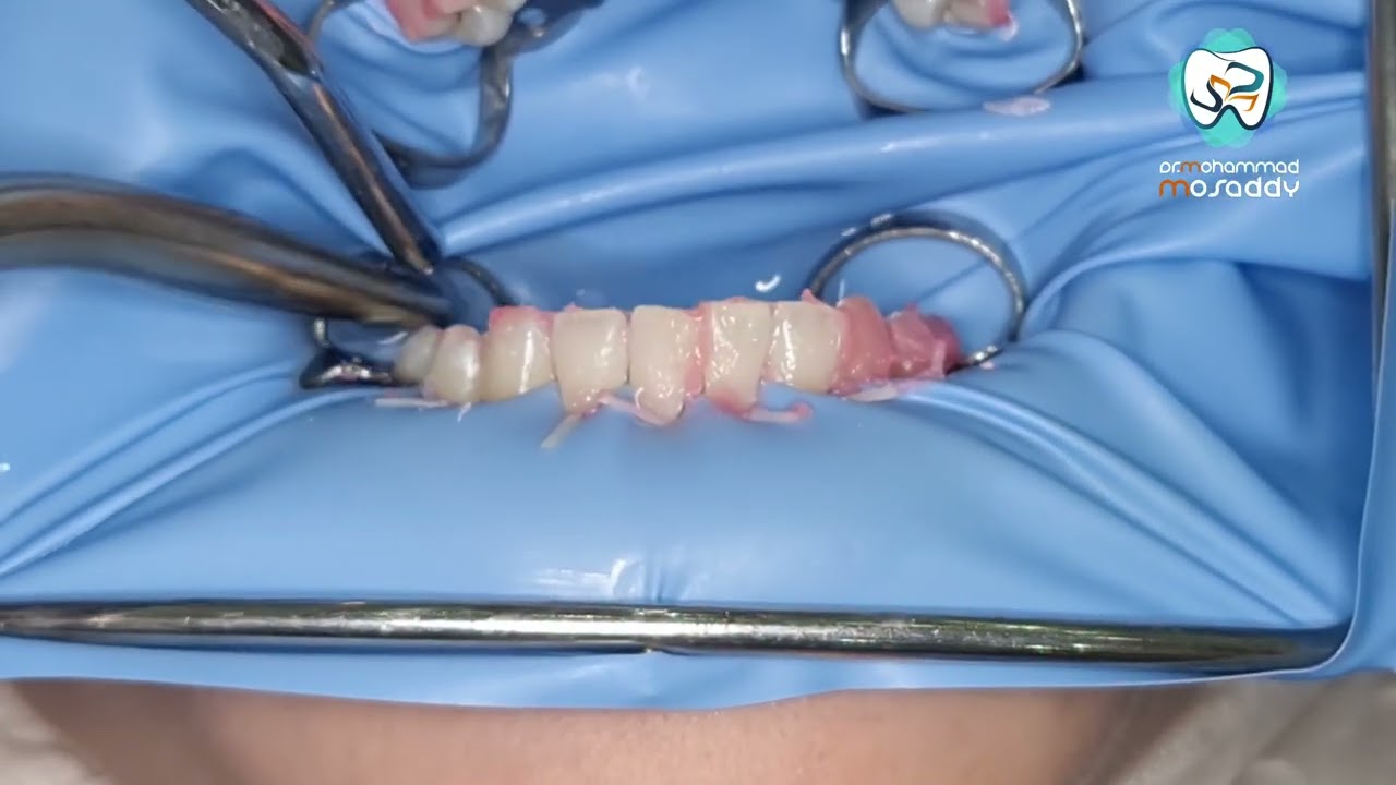 تبيض الاسنان بالديود ليزر     teeth whitning by diode leaser