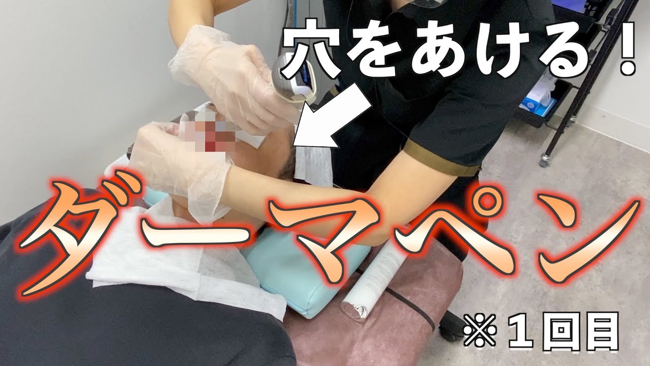 【ダーマペン 1回目】毛穴の開きを気にしてダーマペンしたら赤っ鼻になりました【ゴリラクリニック】