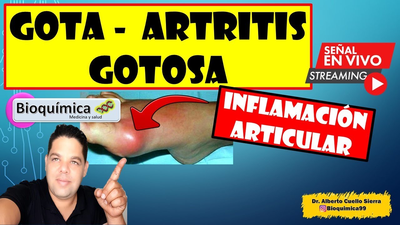 Gota, artritis gotosa, síntomas, tratamiento y prevención