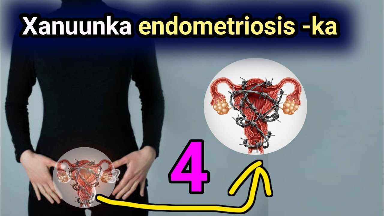 Waa maxay xanuunka endometriosis  ? Calaamadaha lagu garto , waxa sababo iyo qataraha qofka unugleyo