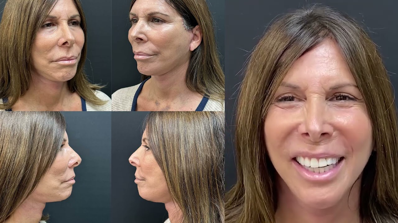 Lower Face & Neck Lift patient journey | Dr.Kusuma
