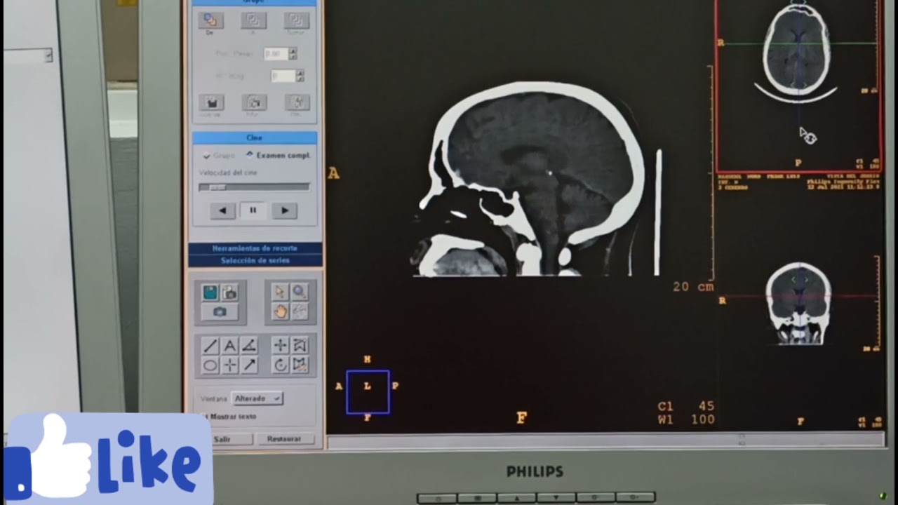 c&oacute;mo reconstruir una tomograf&iacute;a de cr&aacute;neo simple, en corte axial, coronal, sagital y 3D.