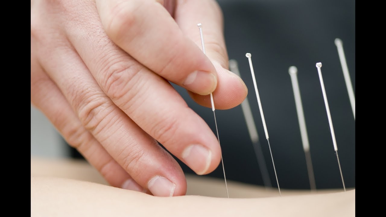Dry Needling / Agulhamento Seco (Trigger Points) Clínica de Fisioterapia Dr. Robson Sitta