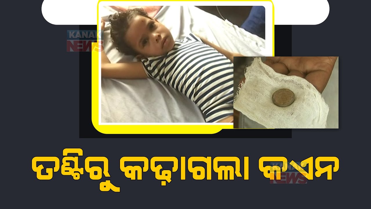 Rs 5 Coin Removed From Throat Of 7 Yr Old Girl By Doctors At SCB Medical In Cuttack