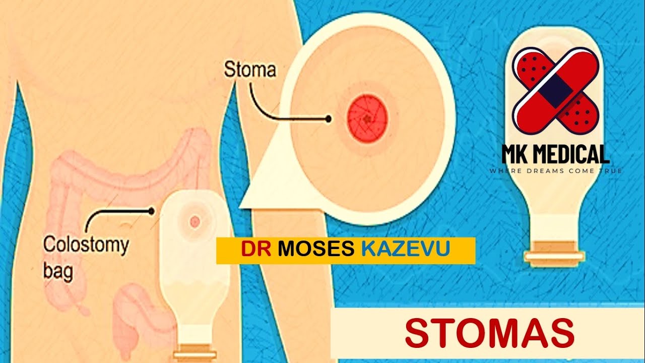 Stomas