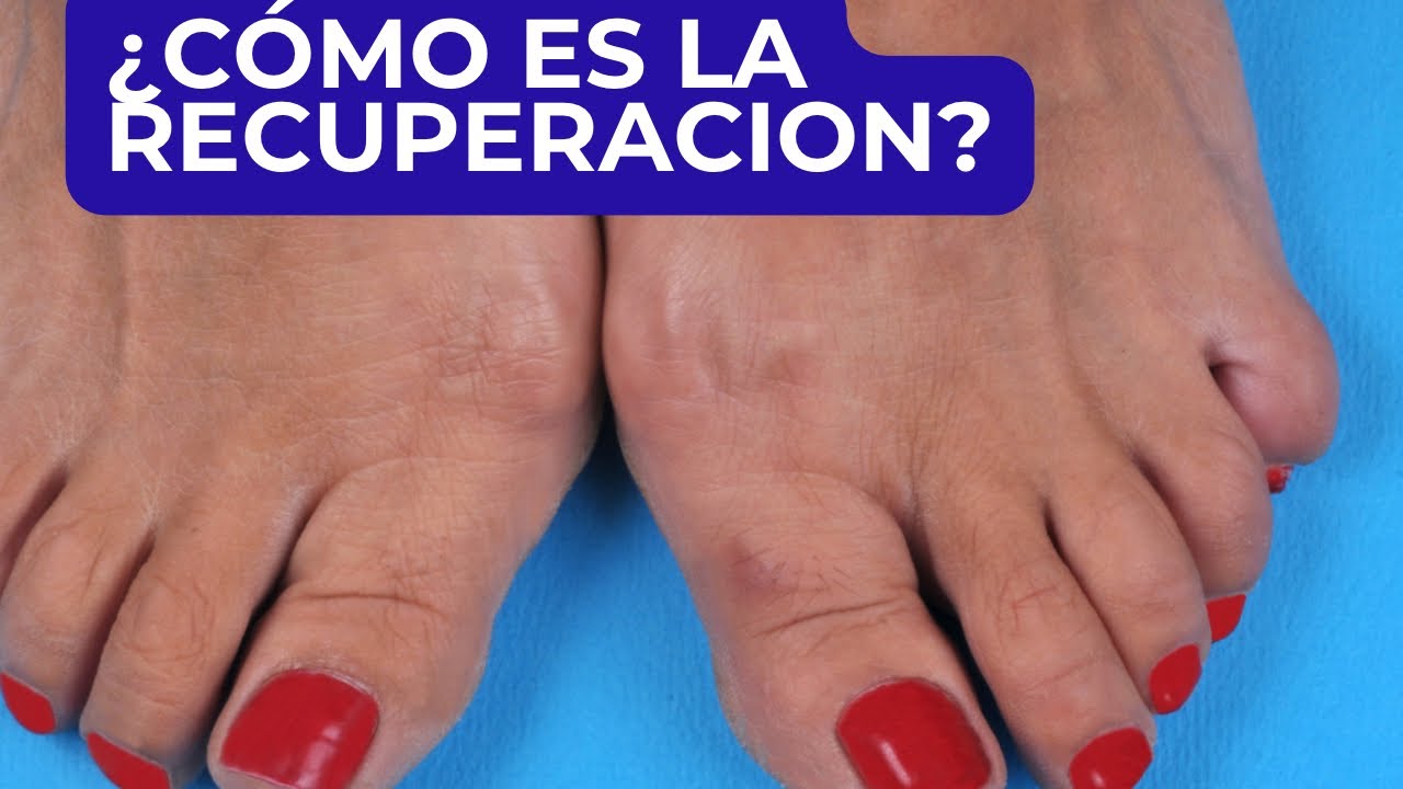 OPERACI&Oacute;N DE JUANETES : TIEMPO DE RECUPERACI&Oacute;N 🤗🤗👈 #juancalbornoz #recuperaci&oacute;ndejuanetes