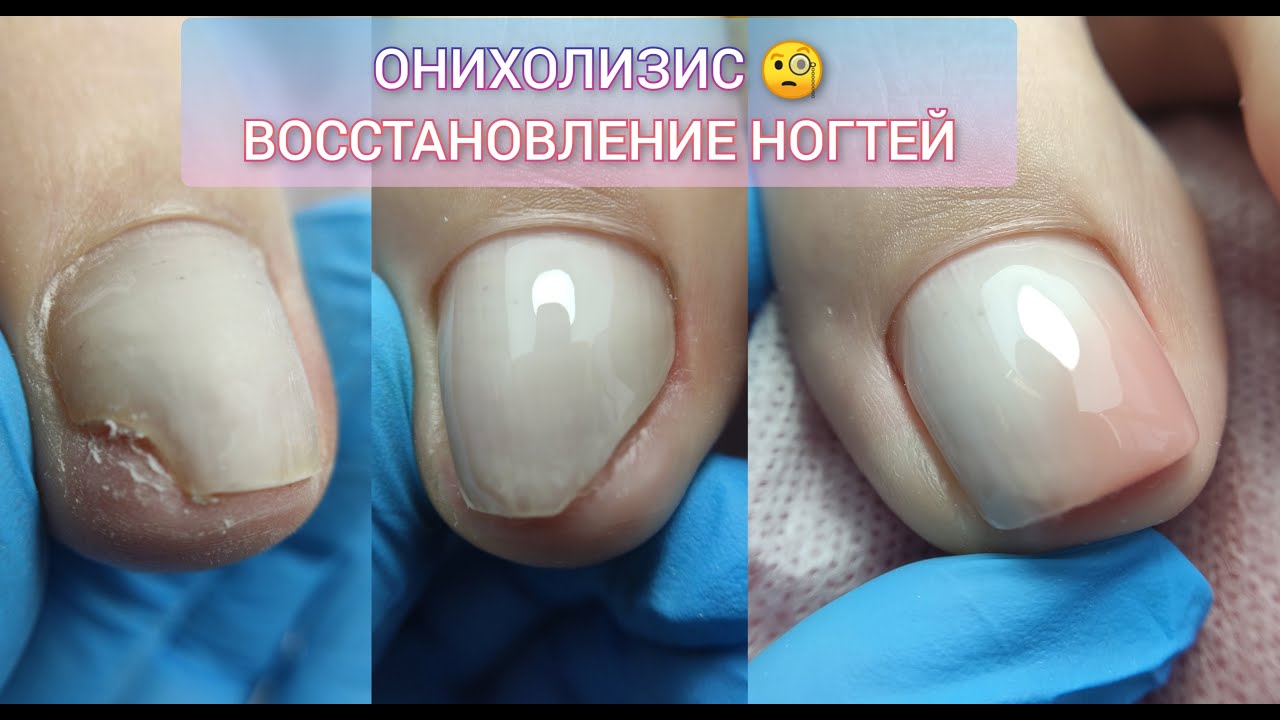 КОМБО🔥 ОНИХОЛИЗИС + ПОДНОГТЕВЫЕ МОЗОЛИ. ЗАЧИСТКА НОГТЕЙ. КОРРЕКЦИЯ ПРОТЕЗИРОВАНИЯ.АППАРАТНЫЙ ПЕДИКЮР