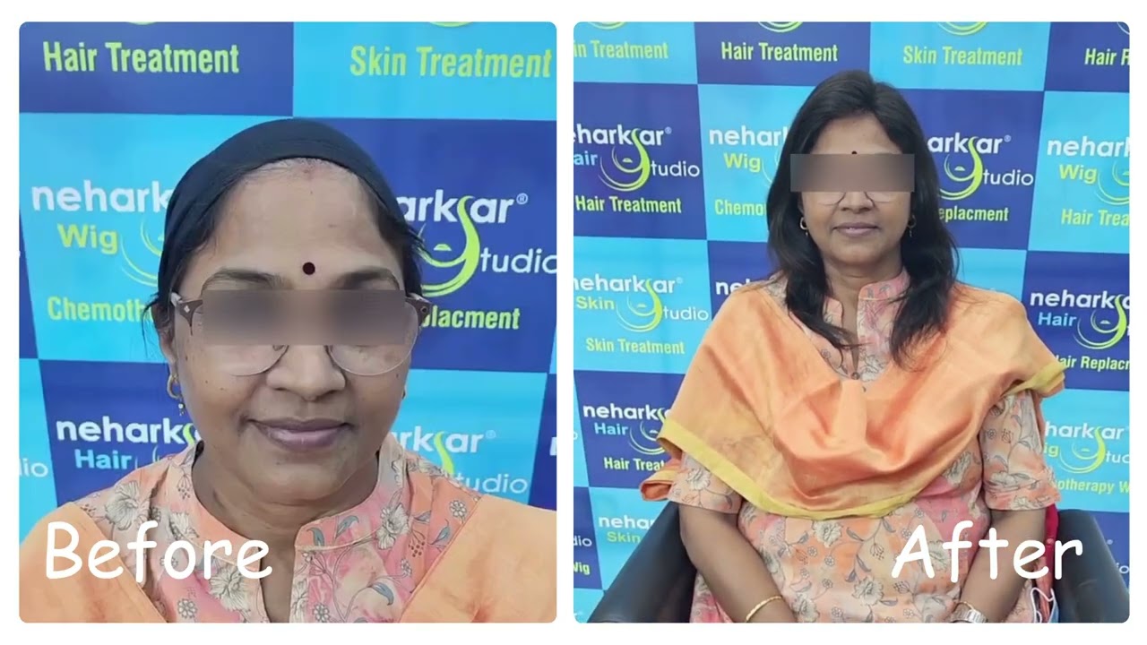 Wigs For Breast Cancer Patients | the best hair wig for cancer patients |Mumbai's best Chemo Wigs |