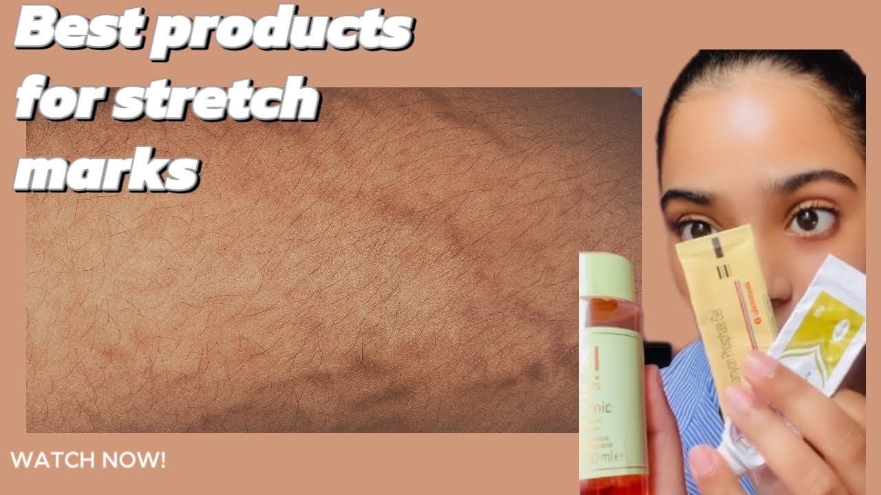 Bleaching ක්‍රීම්‍ ගාලා stretch marks ආපු අයට solution එක| stretch marks වලට හොදම විසදුම🤫