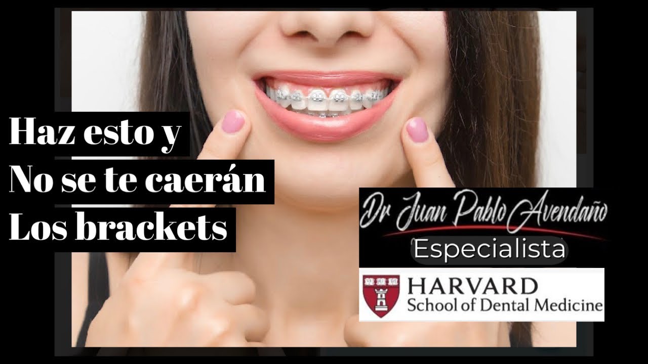 &iquest;Como Comer con BRACKETS RECI&Eacute;N PUESTOS?Alimentos que NO SE DEBEN comer con ortodoncia #odontologia
