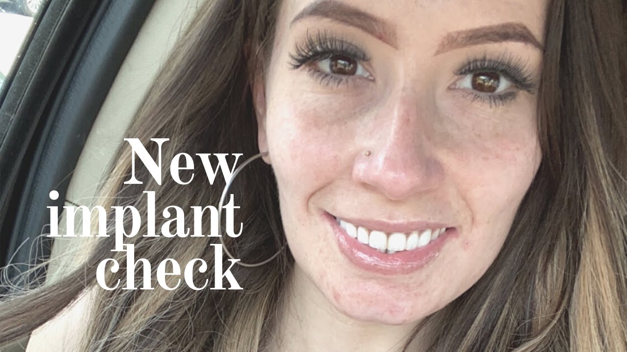 1 week check on NEW mini implants & UPDATES🚨