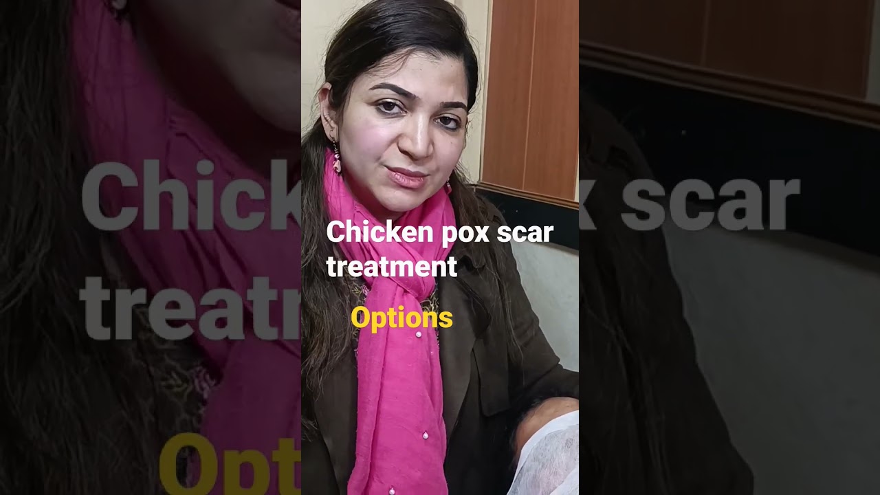 Chicken Pox Scar Treatment By Laser / Filler | Remove Chicken Pox Scars From Face Hindi Aisha Ghias