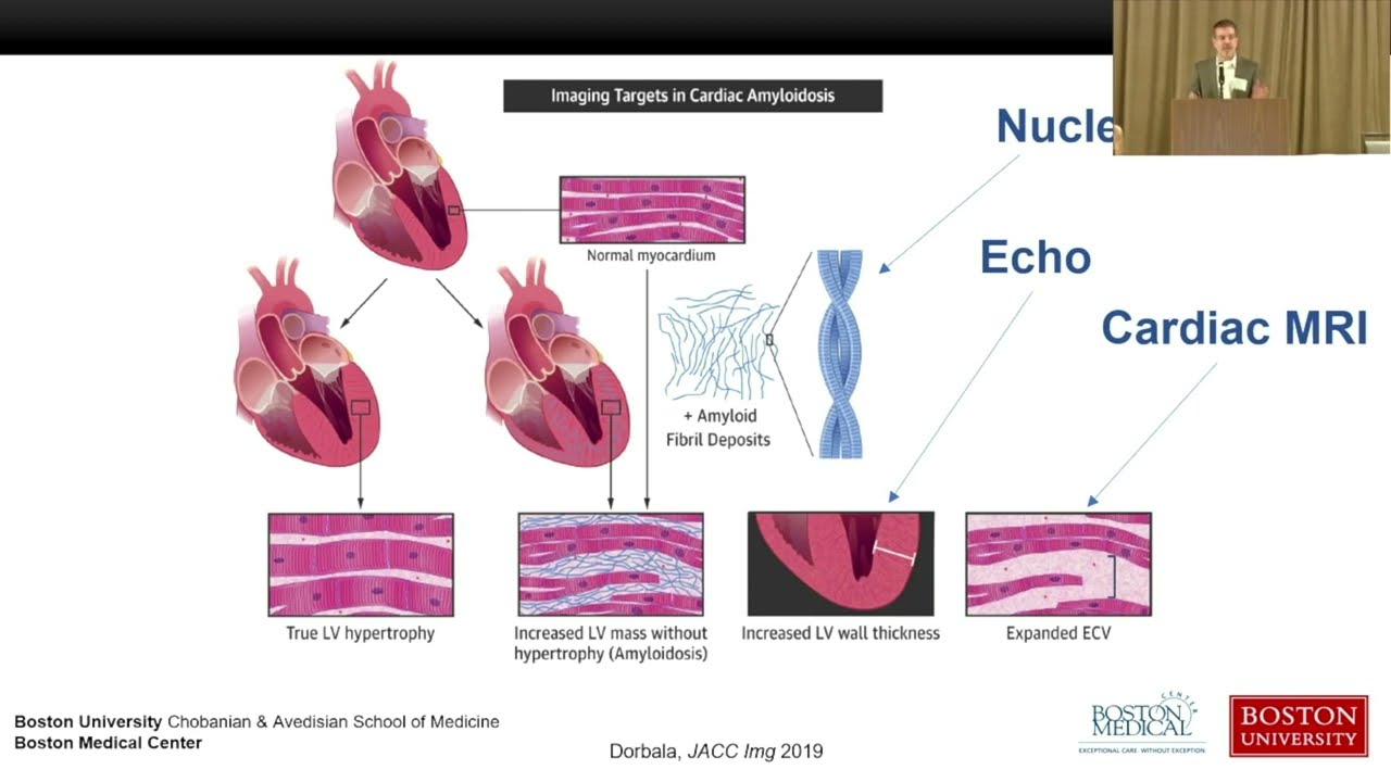 Imaging in ATTR Cardiac Amyloidosis: How it is used for Diagnosis and Treatment Response