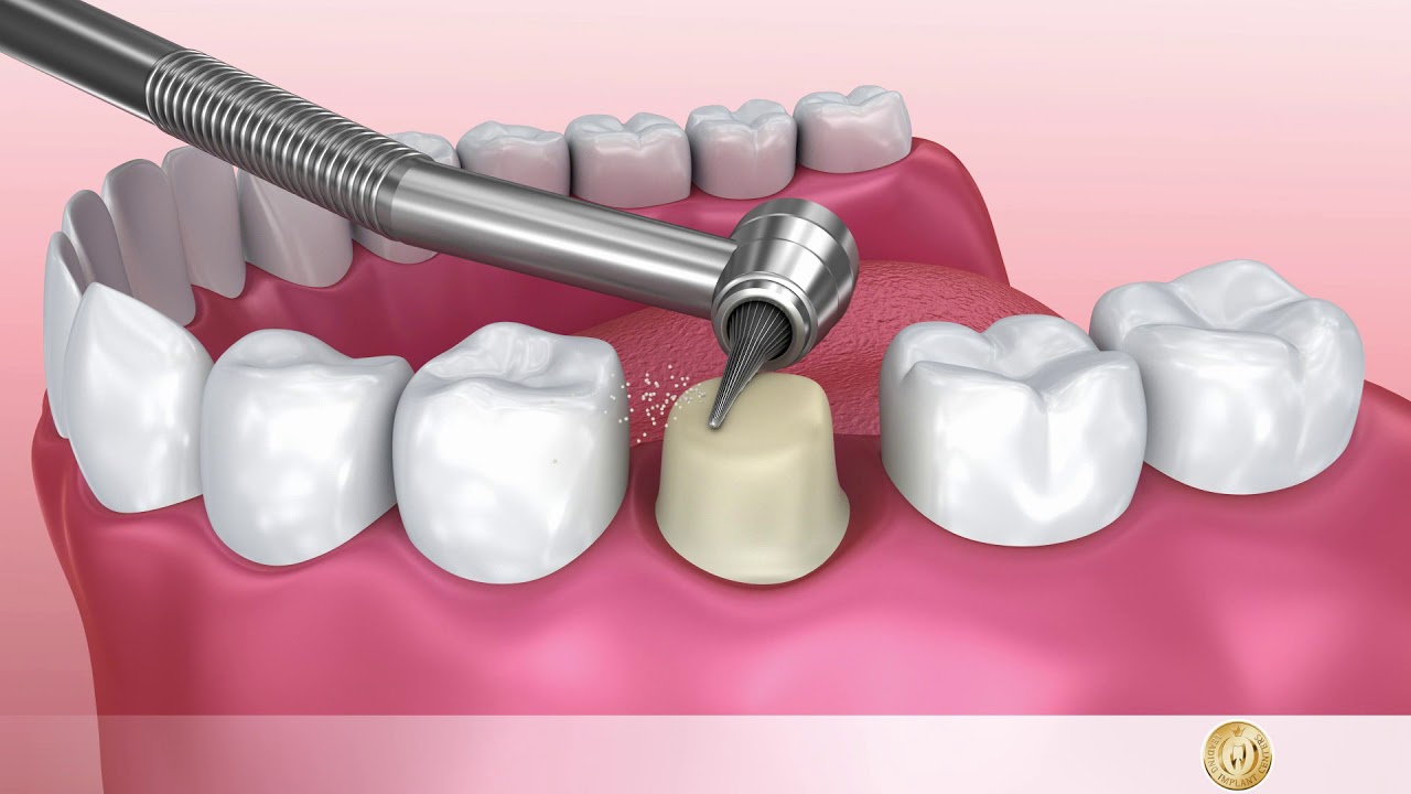 Zahnersatz: Zahnkrone