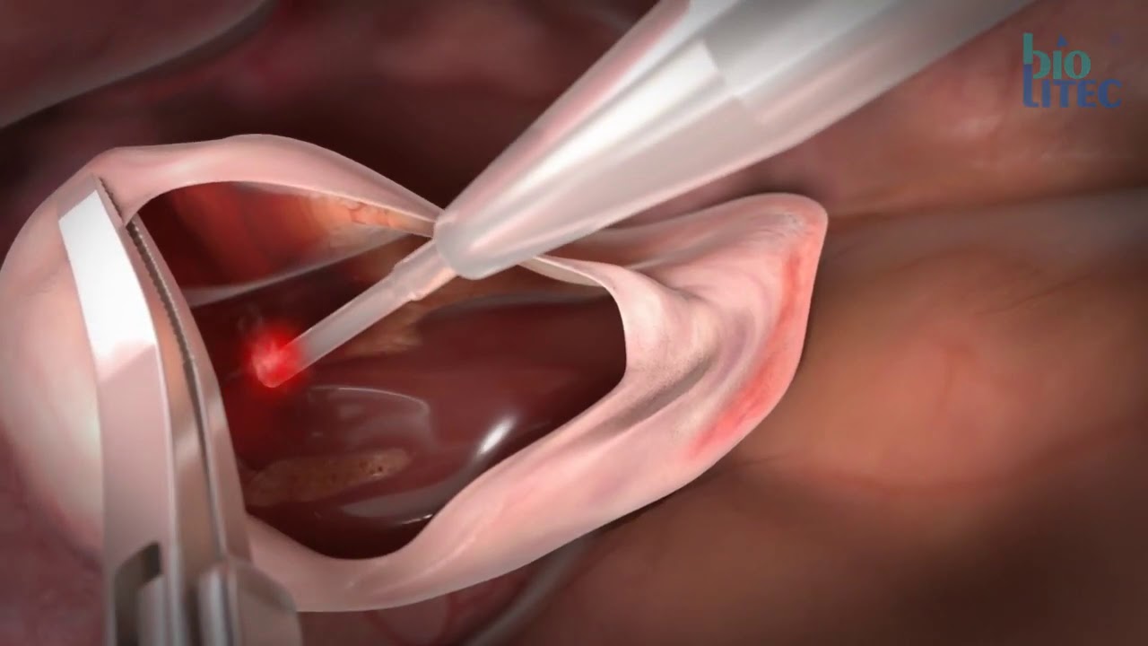 ELLA&reg;   Animation laparoscopic laser procedures with LEONARDO&reg; DUAL by biolitec&reg;