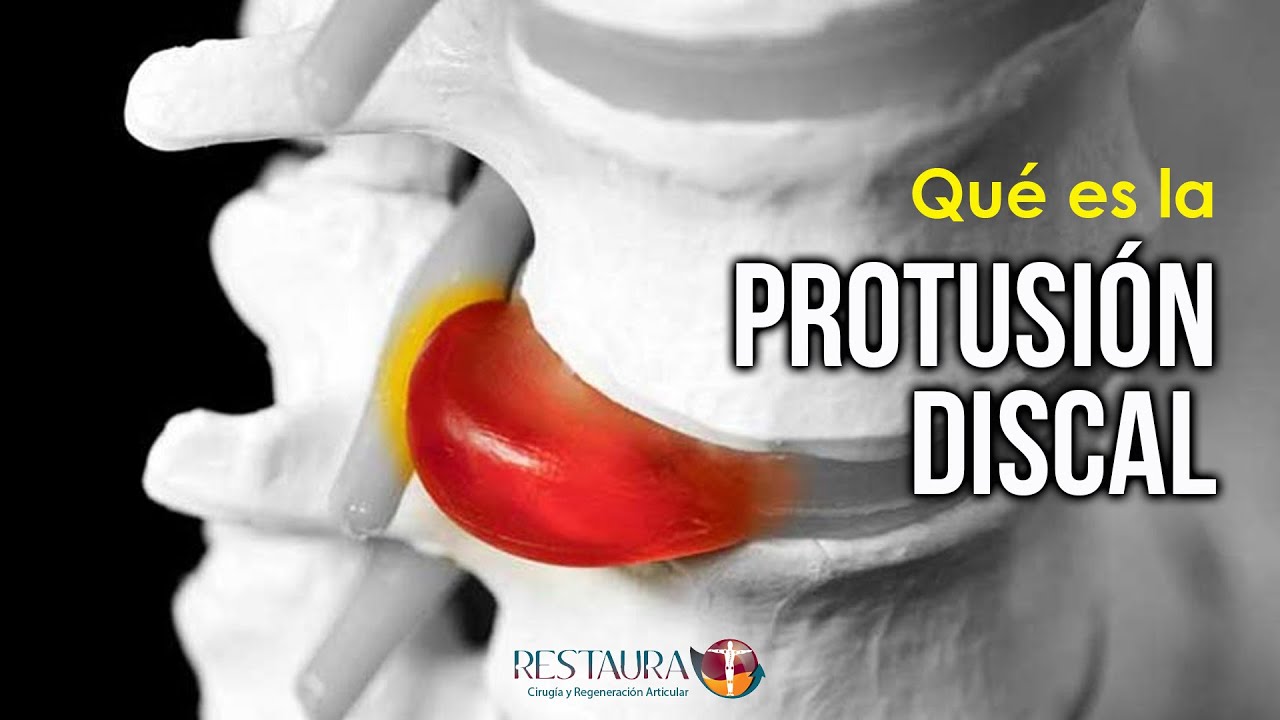 &iquest;Qu&eacute; es la protusi&oacute;n discal? &iquest;No es lo mismo que la hernia de disco?