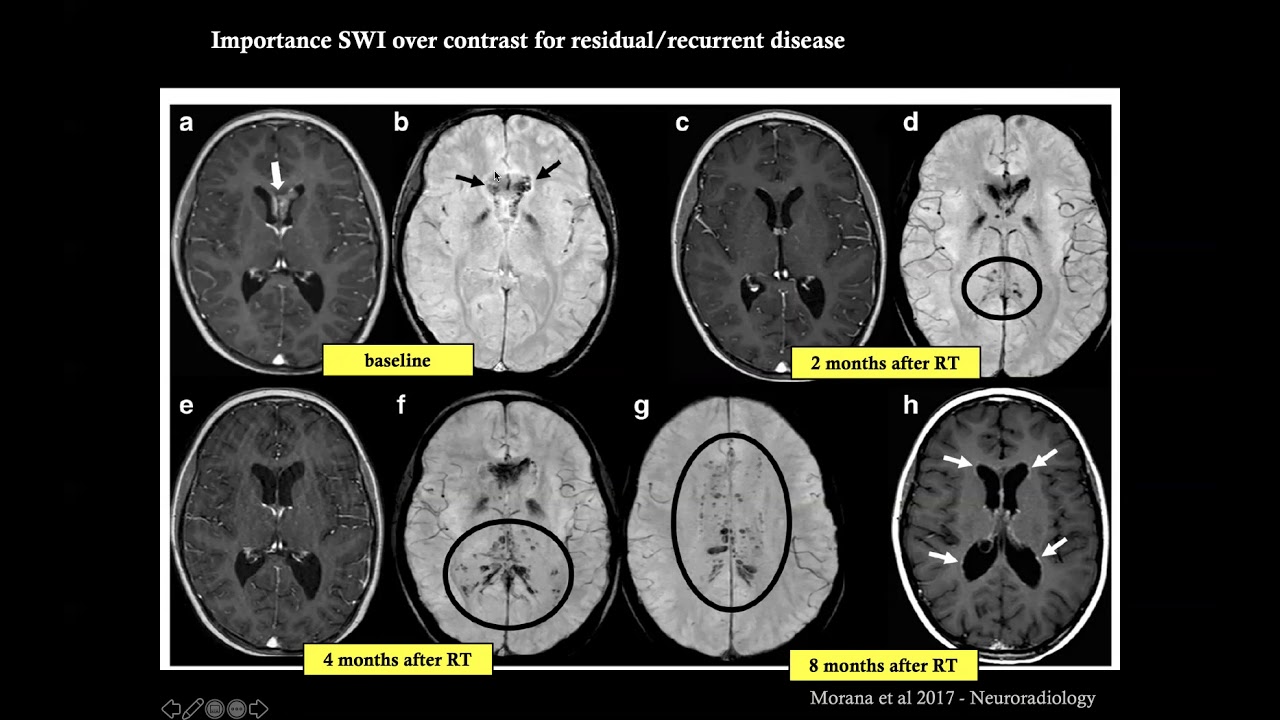 Sellar and Pineal region tumors in children -  a guide to Differential diagnosis