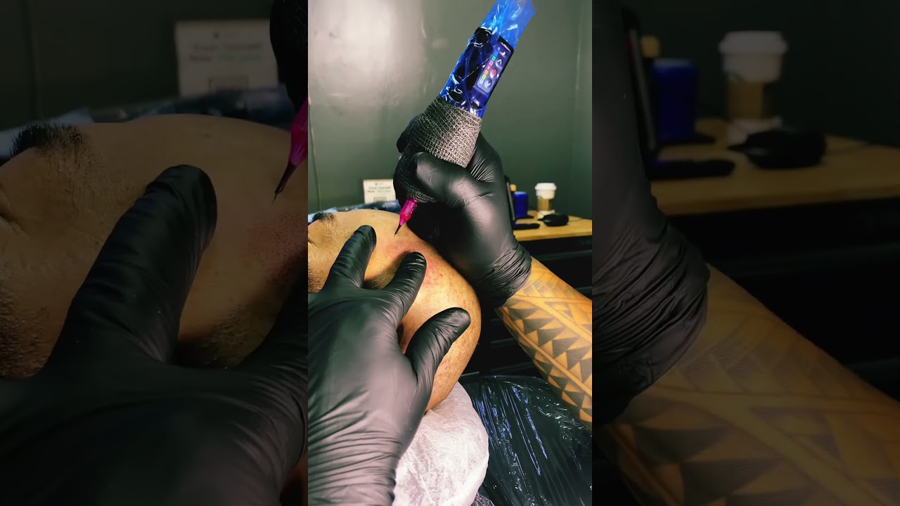 Using Folicule ink wITH FYT needles #hairlinerestoration #scalpmicropigmentation