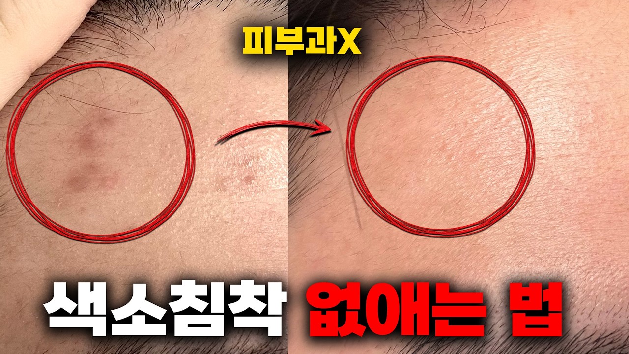 색소침착 관리, 99%가 이걸 몰라서 실패합니다