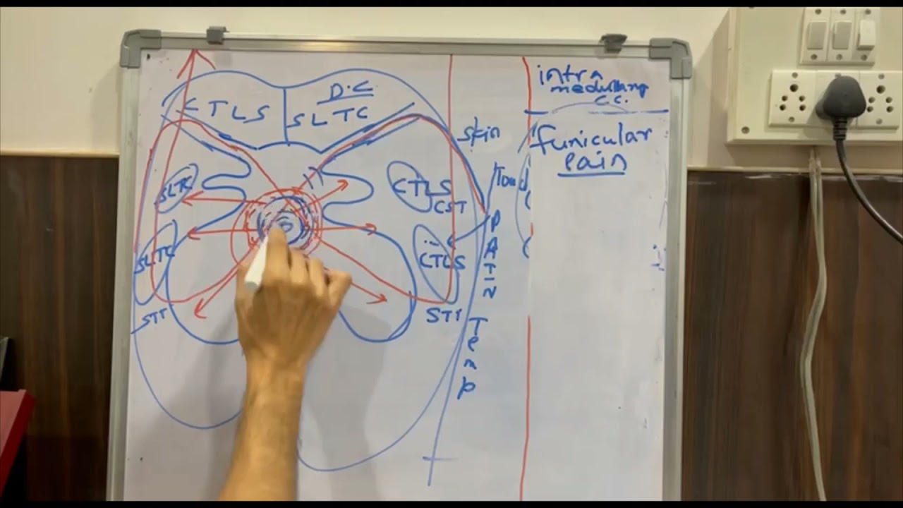 Intramedullary  cord compression, Dept Of Medicine, JNMC