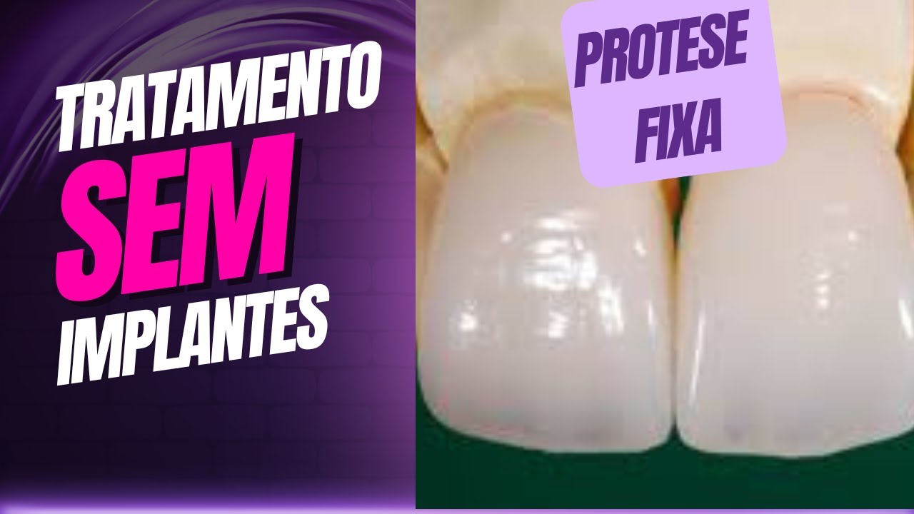 TRATAMENTOS SEM IMPLANTE DENTÁRIO - PROTESE FIXA PARCIAL (PPF)