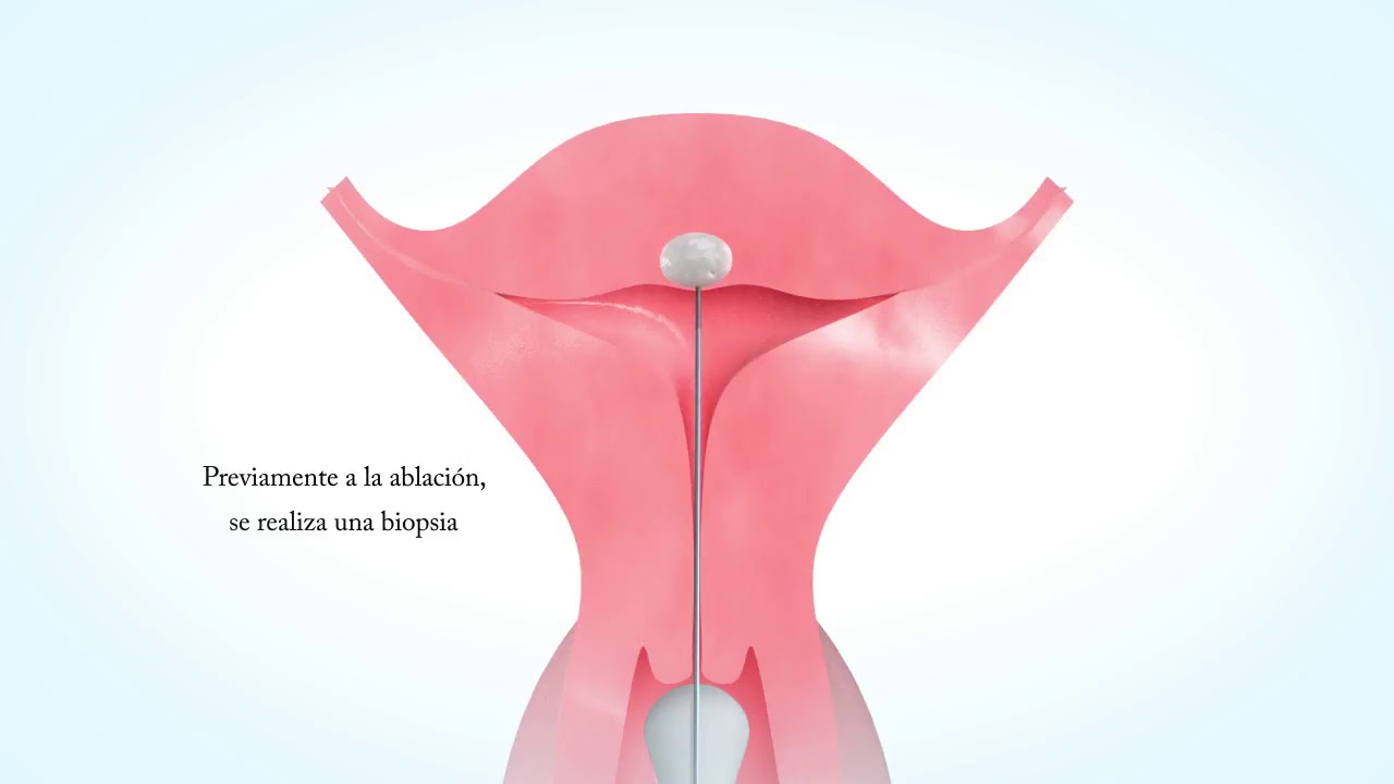 Paso a paso en el tratamiento de radiofrecuencia en miomas