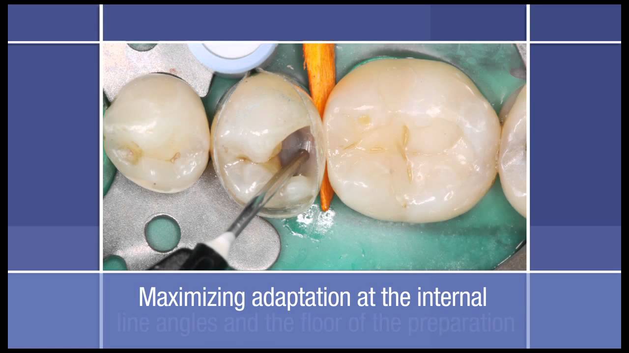 Posterior Restoration: How to use a Flowable Restorative as a Liner in a Class II Dental Restoration
