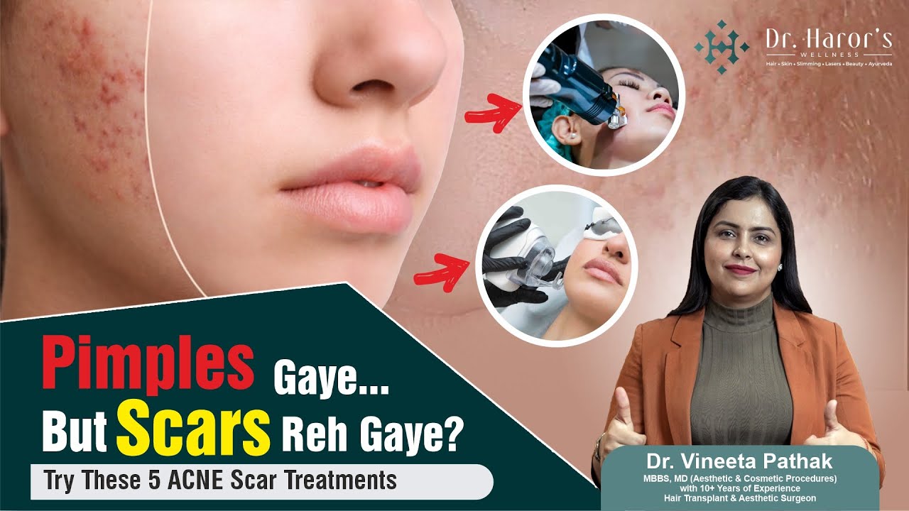 Top #acne  Scar Treatments in #india  | Dermatologist Recommended Treatments  #ytvideo