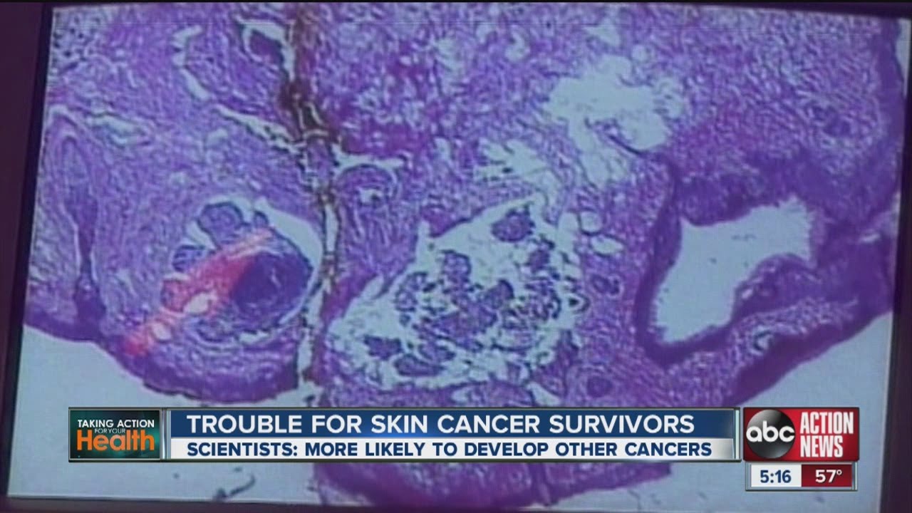 Skin cancer survivors have higher likelihood of getting another form of cancer