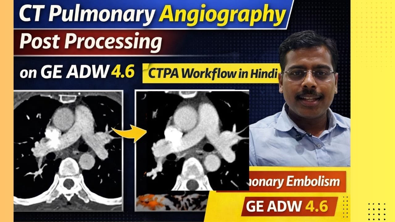 CT Pulmonary Angiography Post Processing on GE ADW 4.6 | CTPA Workflow in Hindi | Pulmonary Embolism