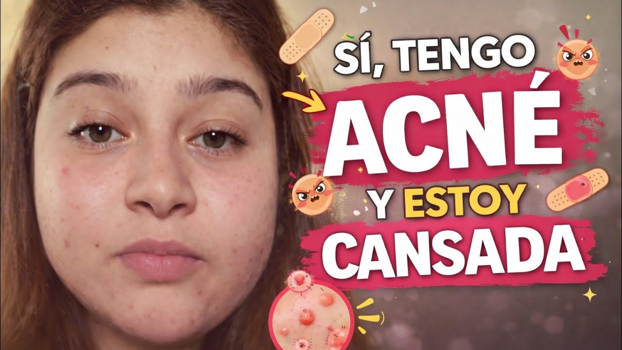 Estoy cansada de que opinen sobre mi piel (sí, tengo acné)