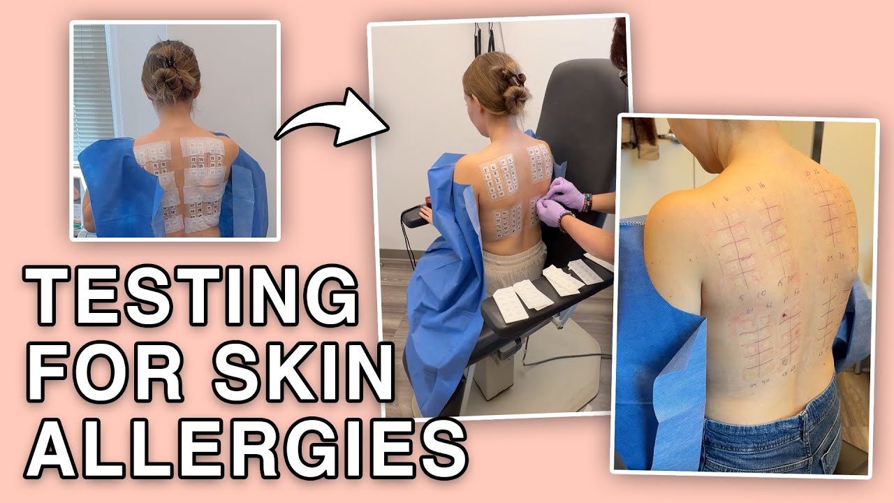 Watch Me Find Out What’s Making My Skin Freak Out!