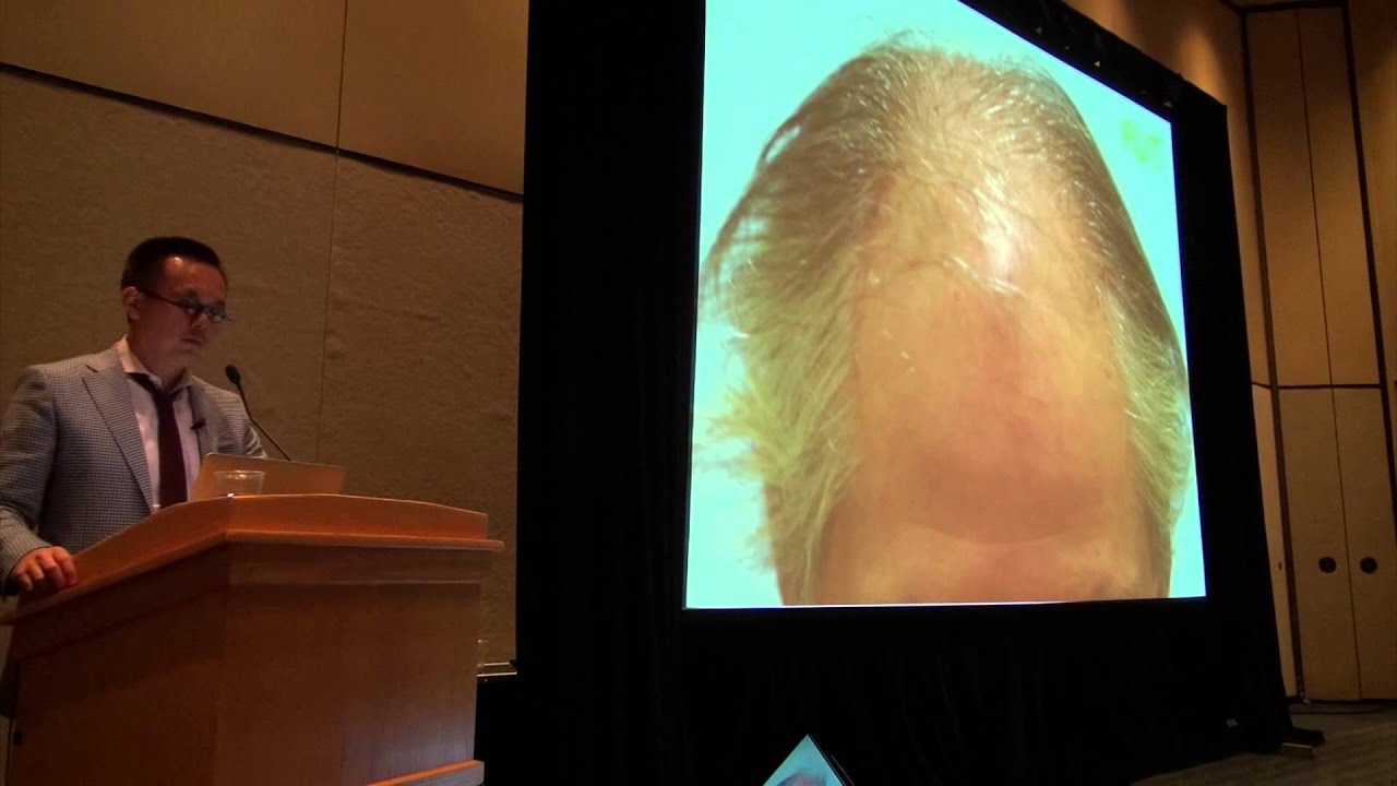 FUE vs  FUT Hair Transplant by Dr. Sam Lam, Dallas Hair Transplant Surgeon