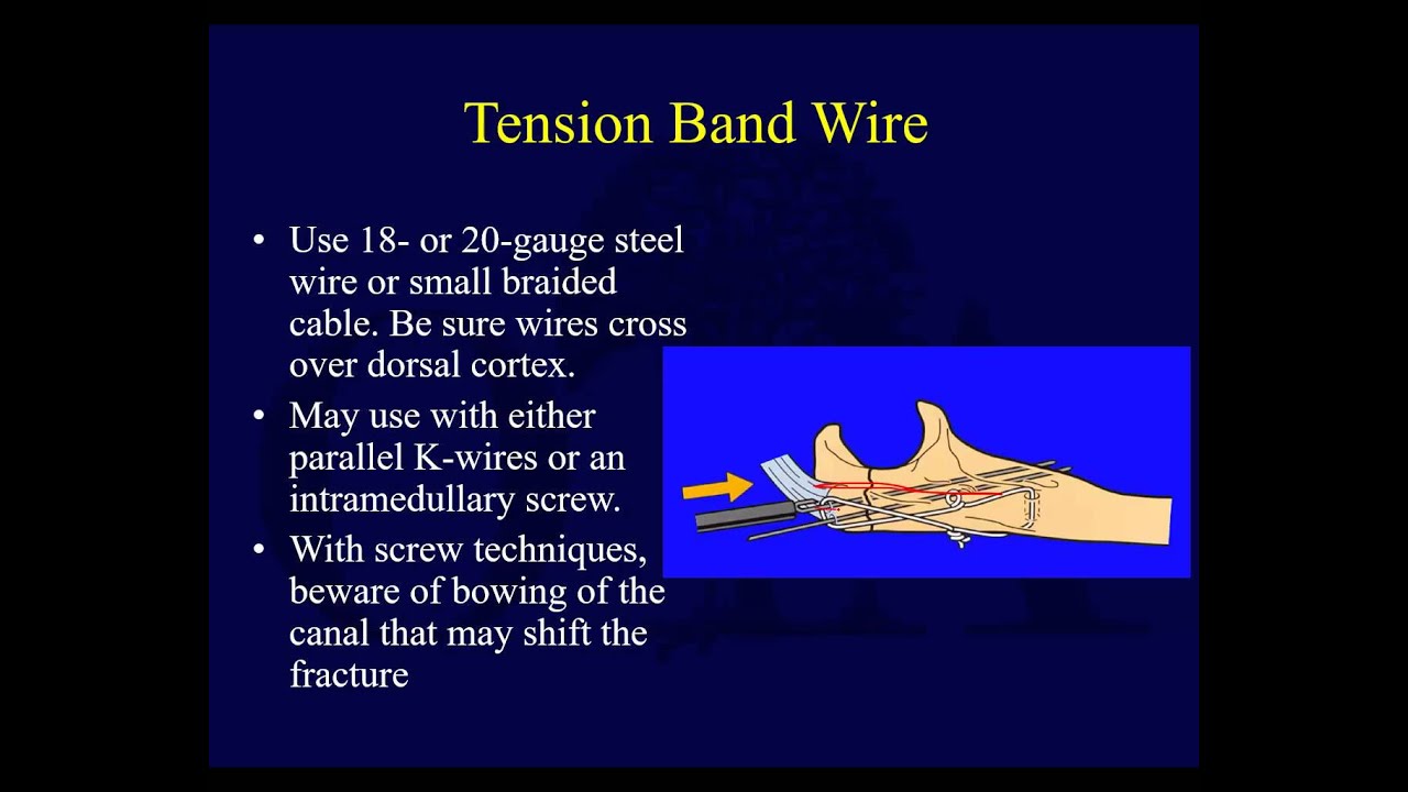 Olecranon Fractures