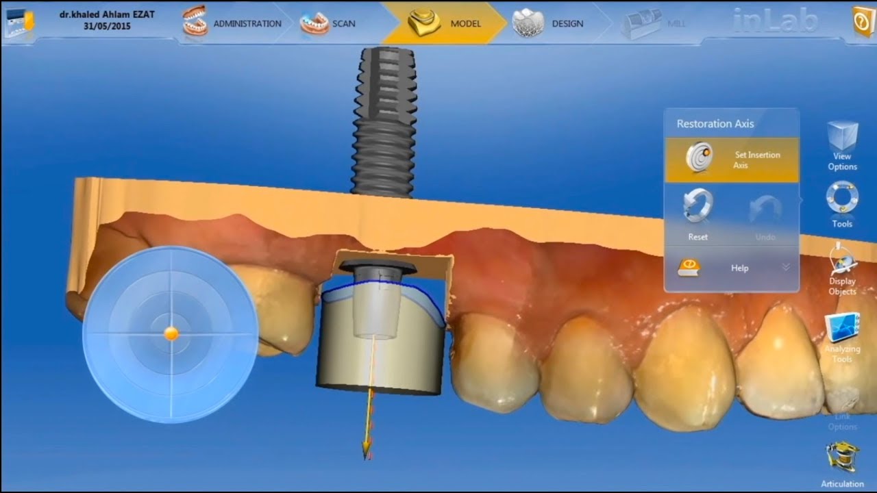 How to restore dental implant in one visit, using Ti-Base (Digital Solution)