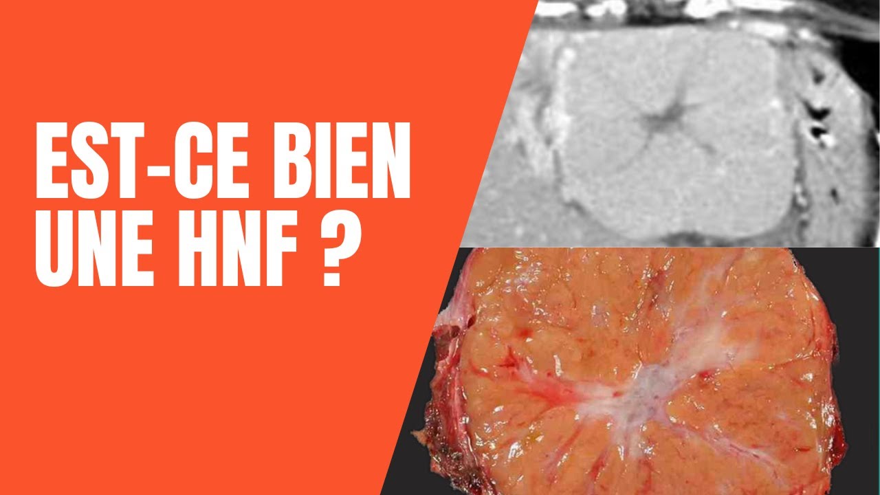 Est-ce bien une HNF (hyperplasie nodulaire focale) - Cours médecine radiologie imagerie