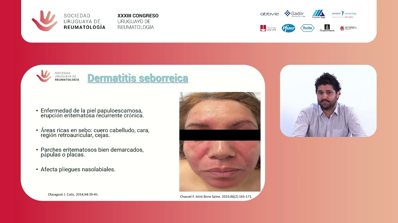 ¿Es Lupus? - Dr. Anthony Henry
