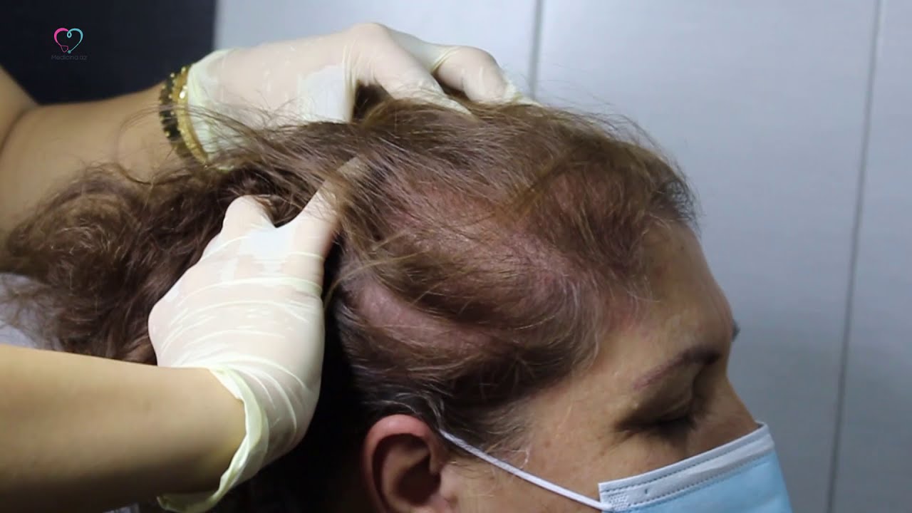 Saç tökülməsinin səbəbləri və mezo prosedur - Kosmetoloq Həcər Hüseynova