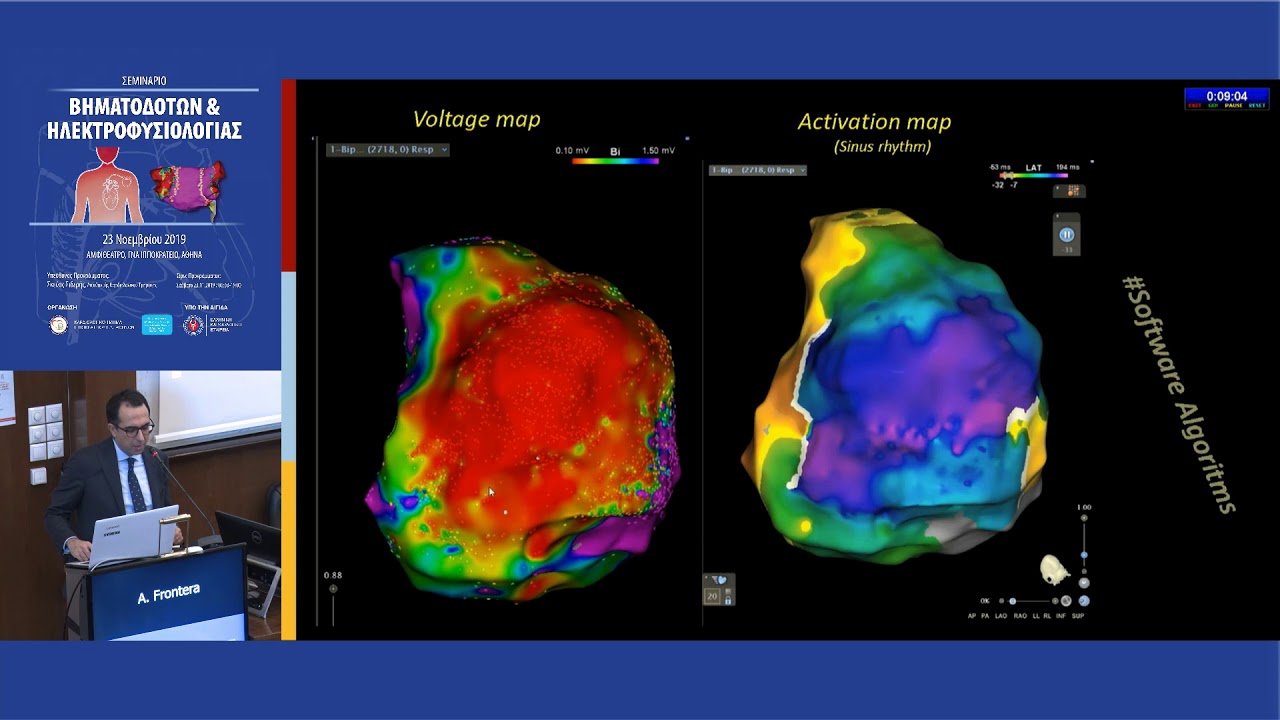 A. Frontera | Substrate mapping in the setting of VT ablation. Past, present and future