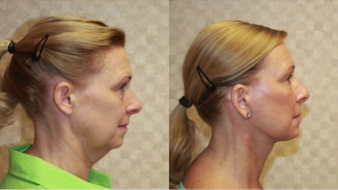 Neck Lift Surgery