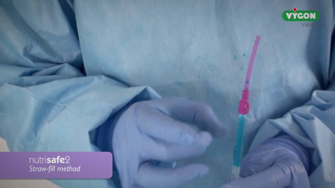 Safety enteral feeding system designed for neonatal patients: Nutrisafe2
