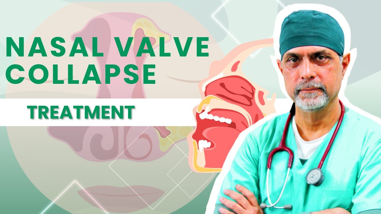 Nasal Valve Collapse - Treatment | नाक का वाल्व ढहना: लक्षण और उपचार | Dr (Major) Rajesh Bhardwaj