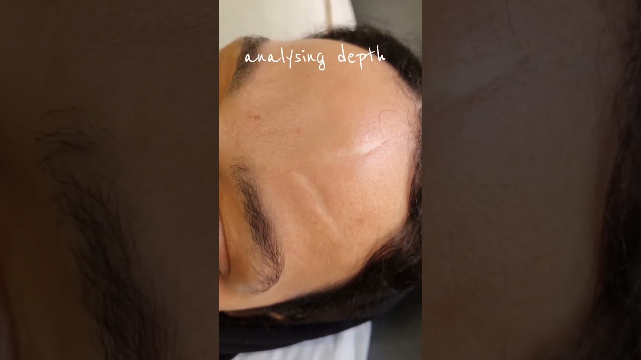 Skin / Scar Camouflage On The Face! Skin Camouflage UK 