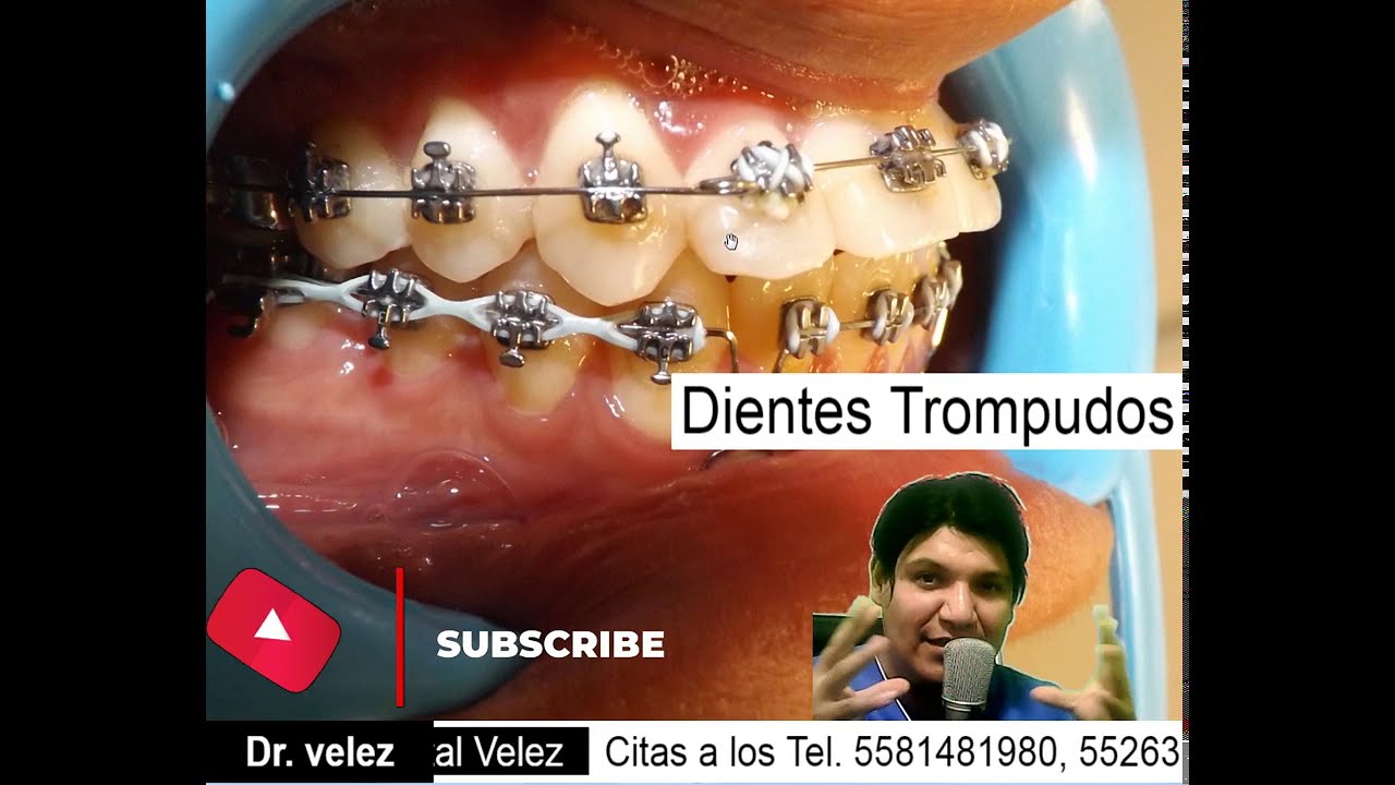Dientes Trompudos Clínica Dental Velez CDMX