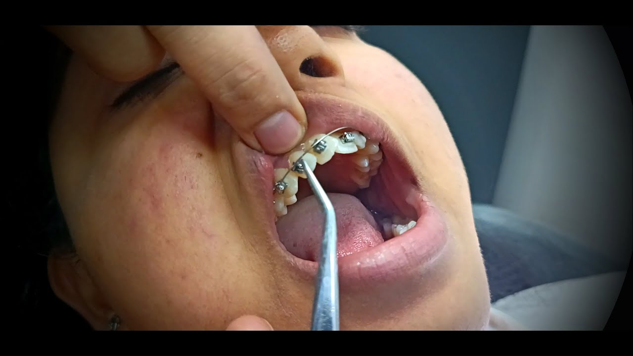 Master the Perfect Wire Changing Sequence in Orthodontics by Dr. Kapil Saroha