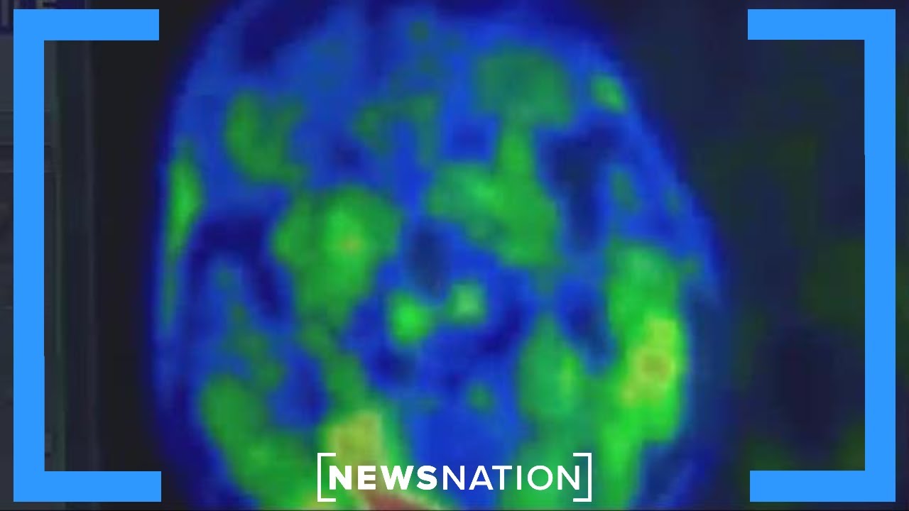 New Alzheimer's treatment cuts risk of disease by 50% | Morning in America