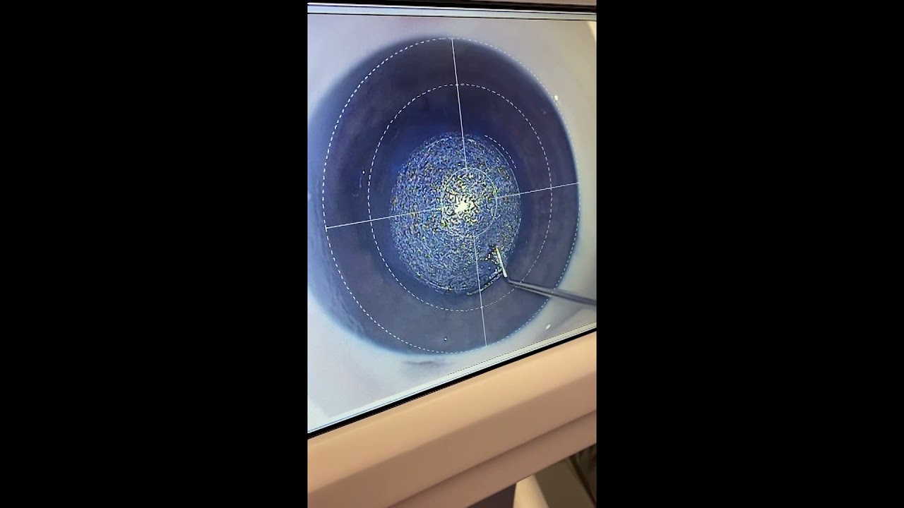 Sesiune Teste Zeiss VisuMax Mel 90