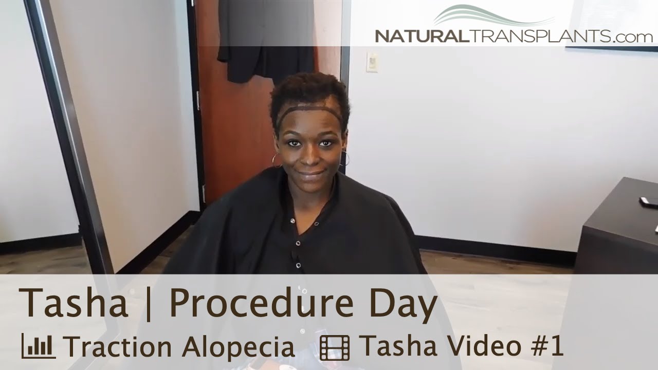 Traction Alopecia Hair Transplant Surgery Day | Dr. Harold Siegel (Tasha)